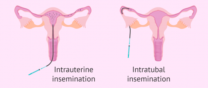 Antisperm antibodies and pregnancy
