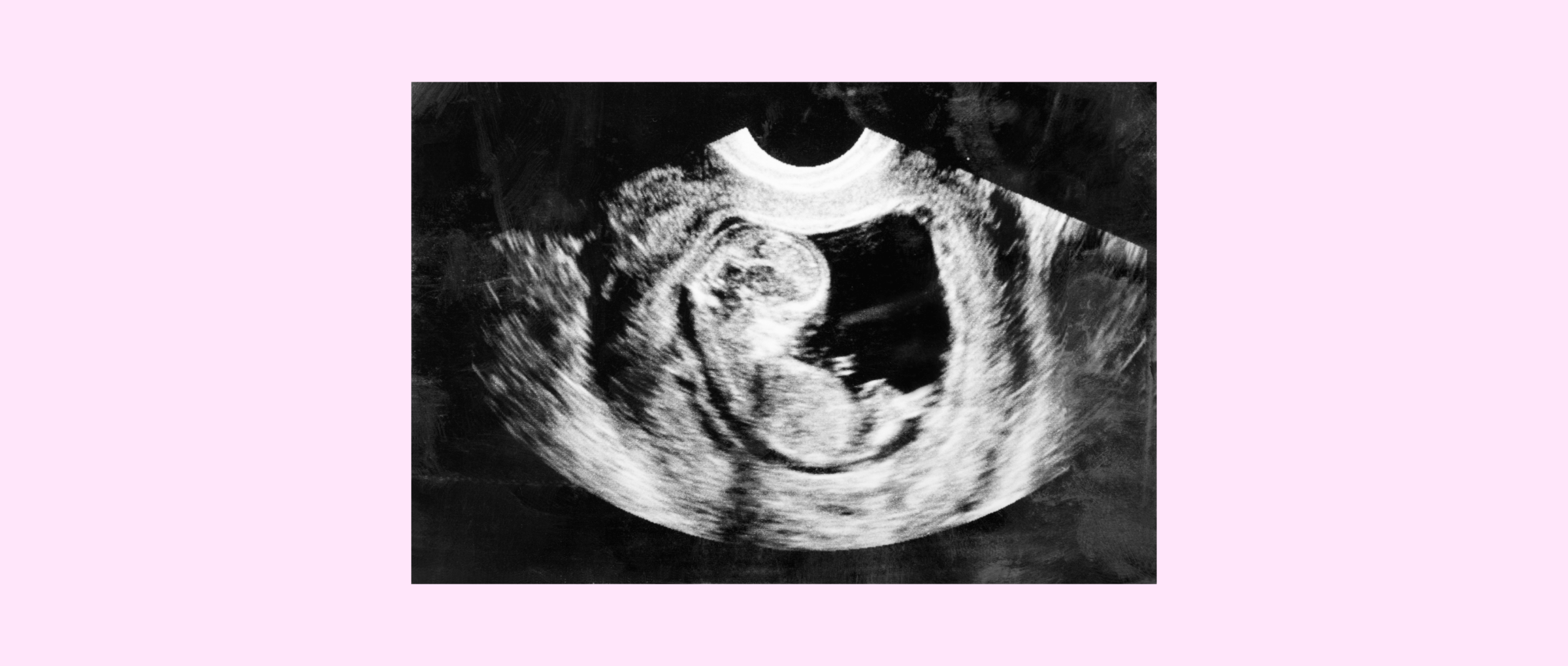 Ultrasound scan in the third month of pregnancy
