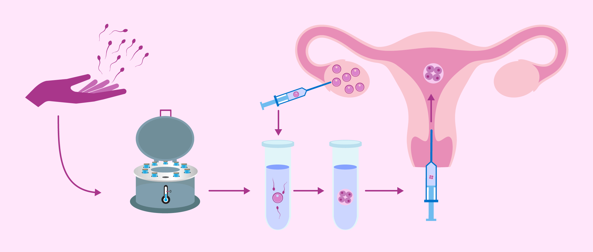 Process Of Ivf With Donor Sperm