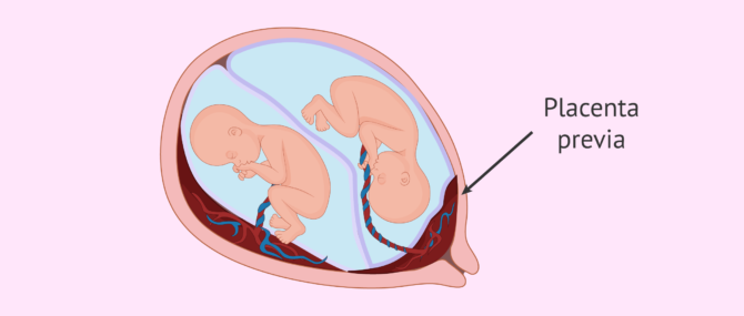 Imagen: Twin- pregnancy with placenta previa