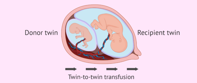 Imagen: Twin to twin transfusion syndrome