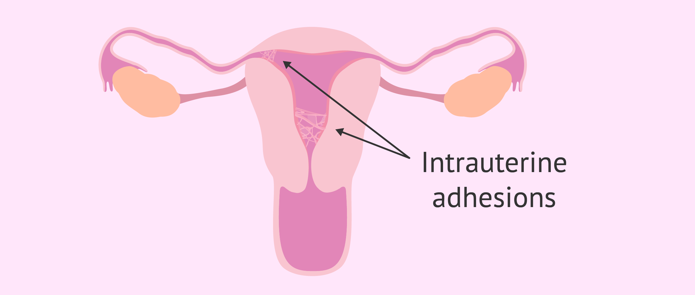 Pelvic or uterine adhesions