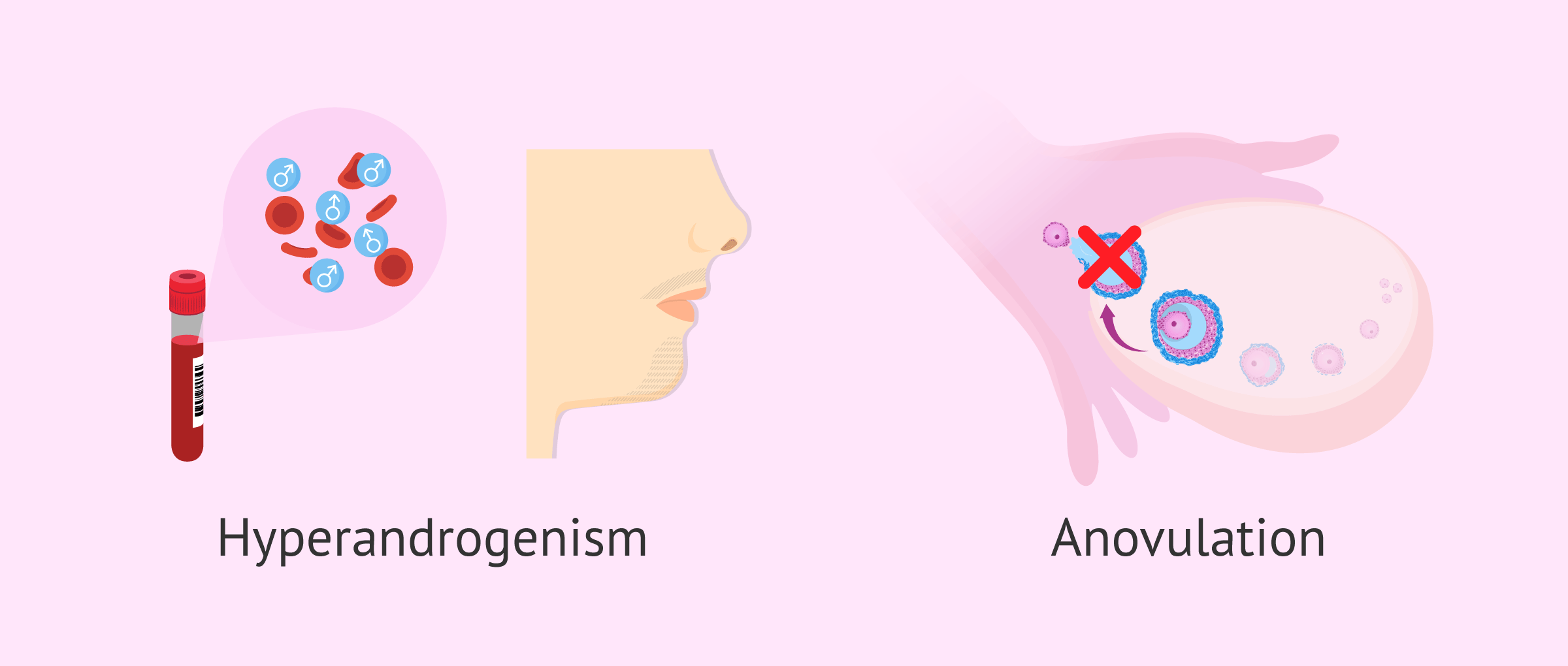 Imagen: Manifestations of PCOS