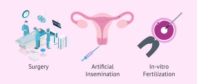Imagen: Varicocele and infertility