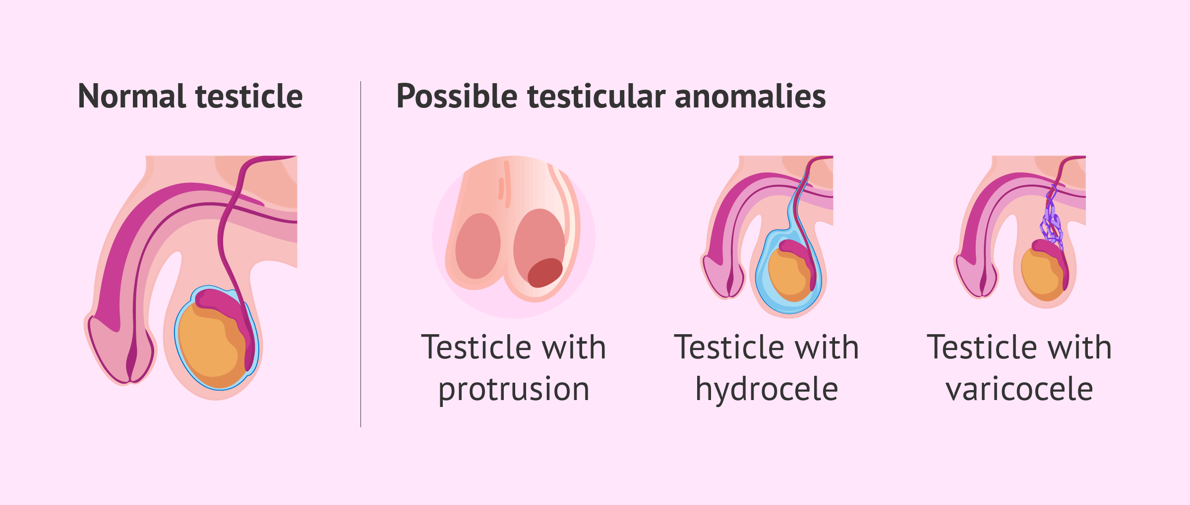 Imagen: What can be noted in a testicular self-examination?