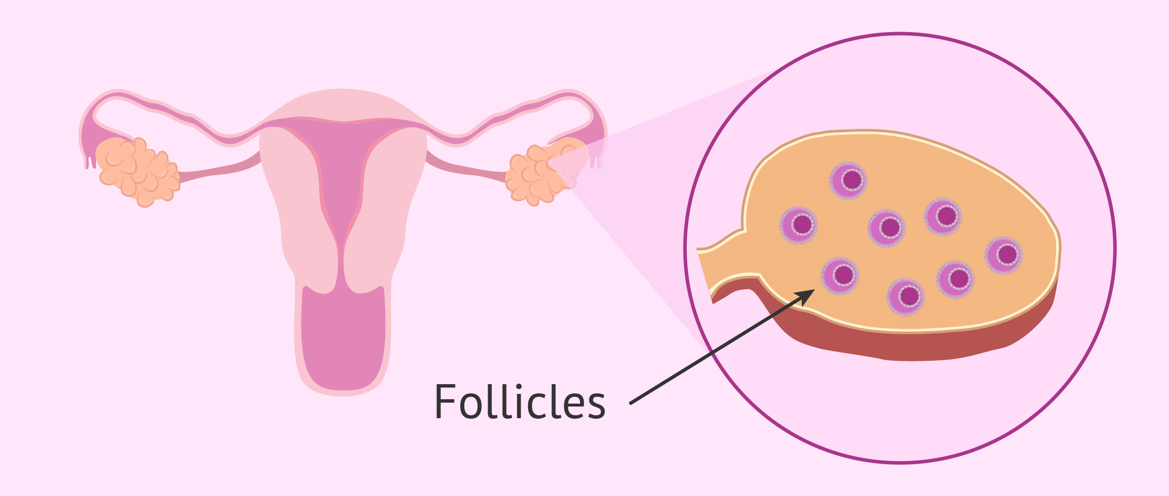Definition of polycystic ovary