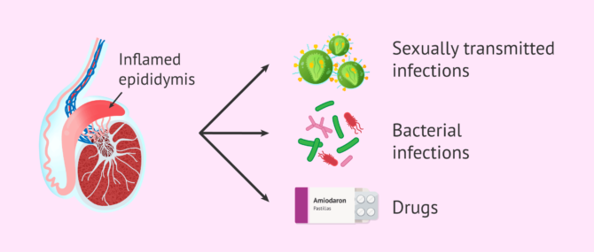 Imagen: Epididymitis and its causes