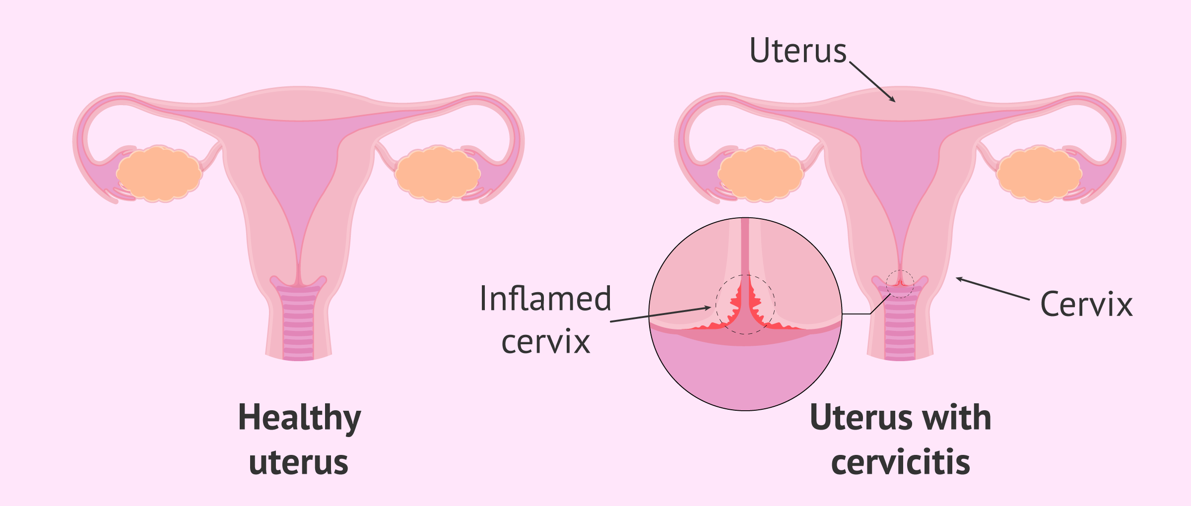 What is cervicitis?