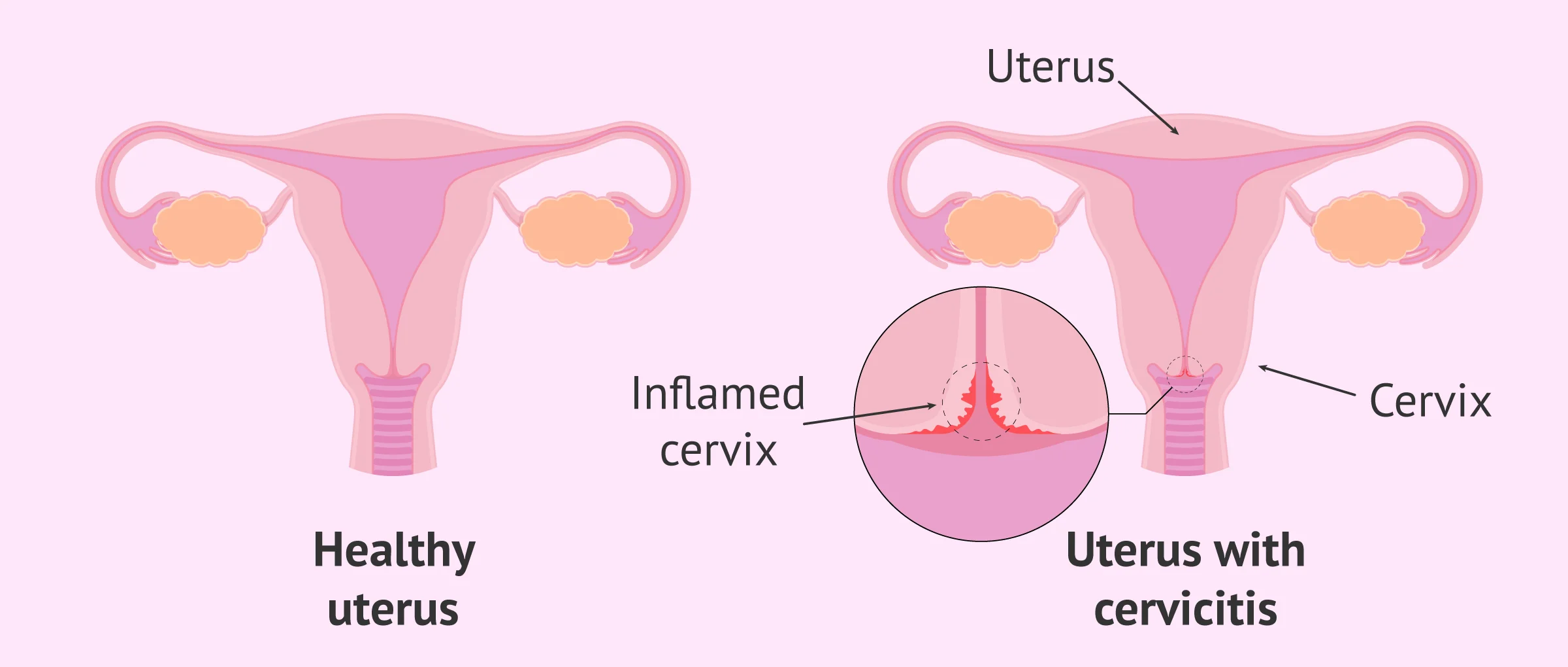 Cervicitis