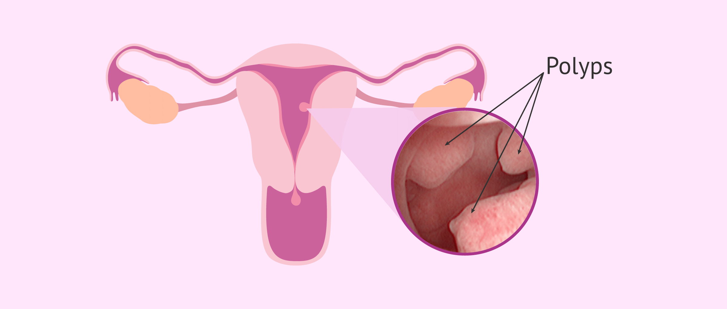 Malignant uterine polyps: types, symptoms and treatments