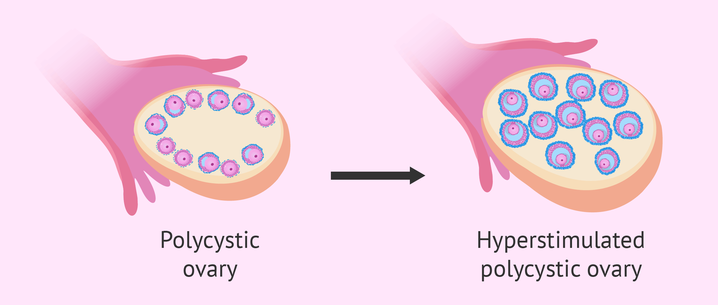 Ovarian Hyperstimulation Syndrome Ultrasound