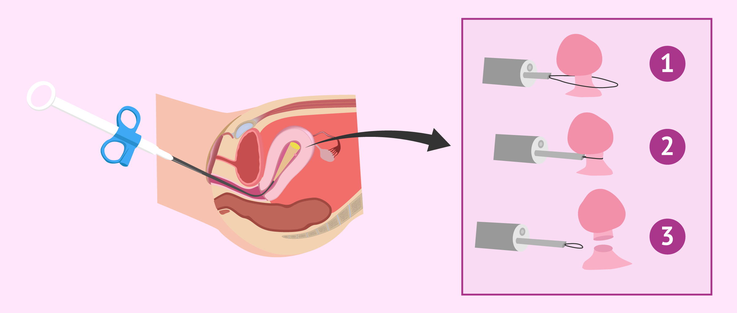 Polypectomy procedure