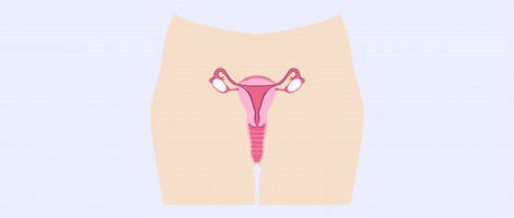 Absent uterus
