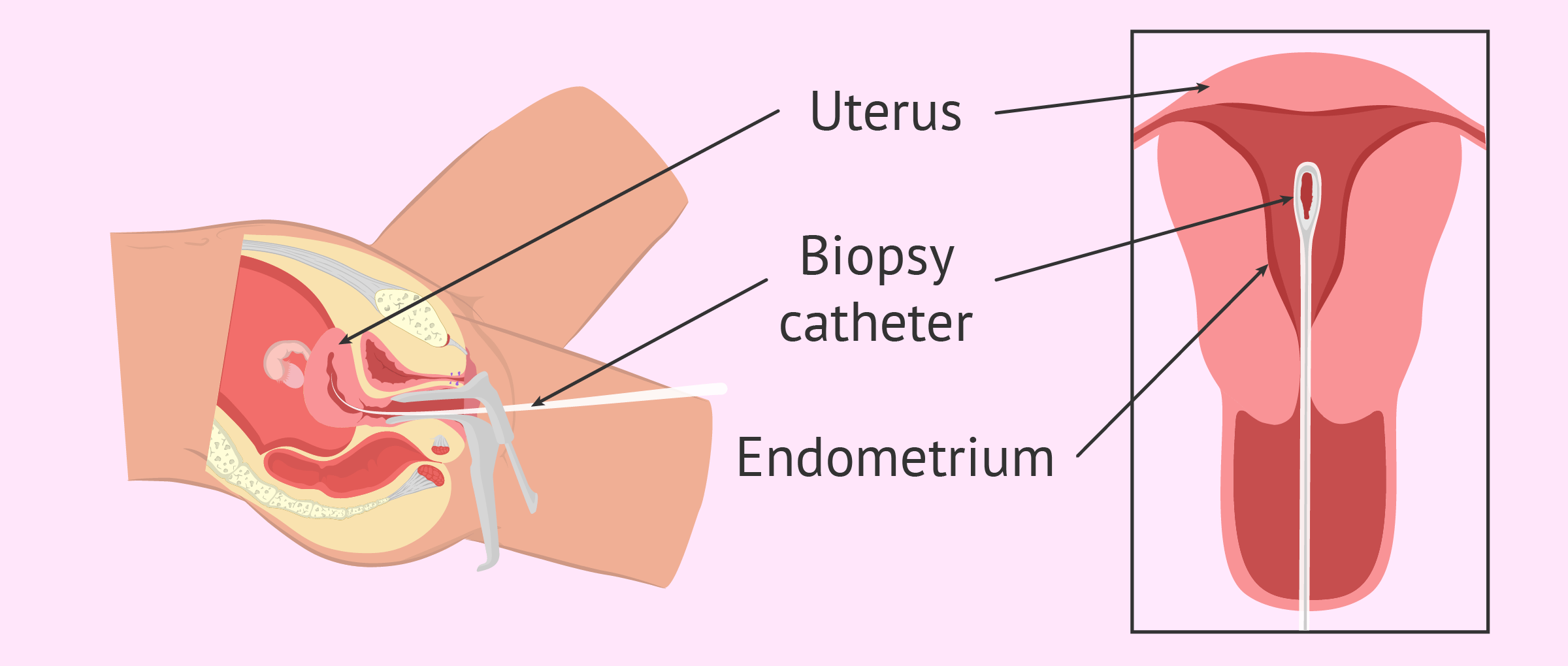 Can an endometrial biopsy tell why you are infertile?