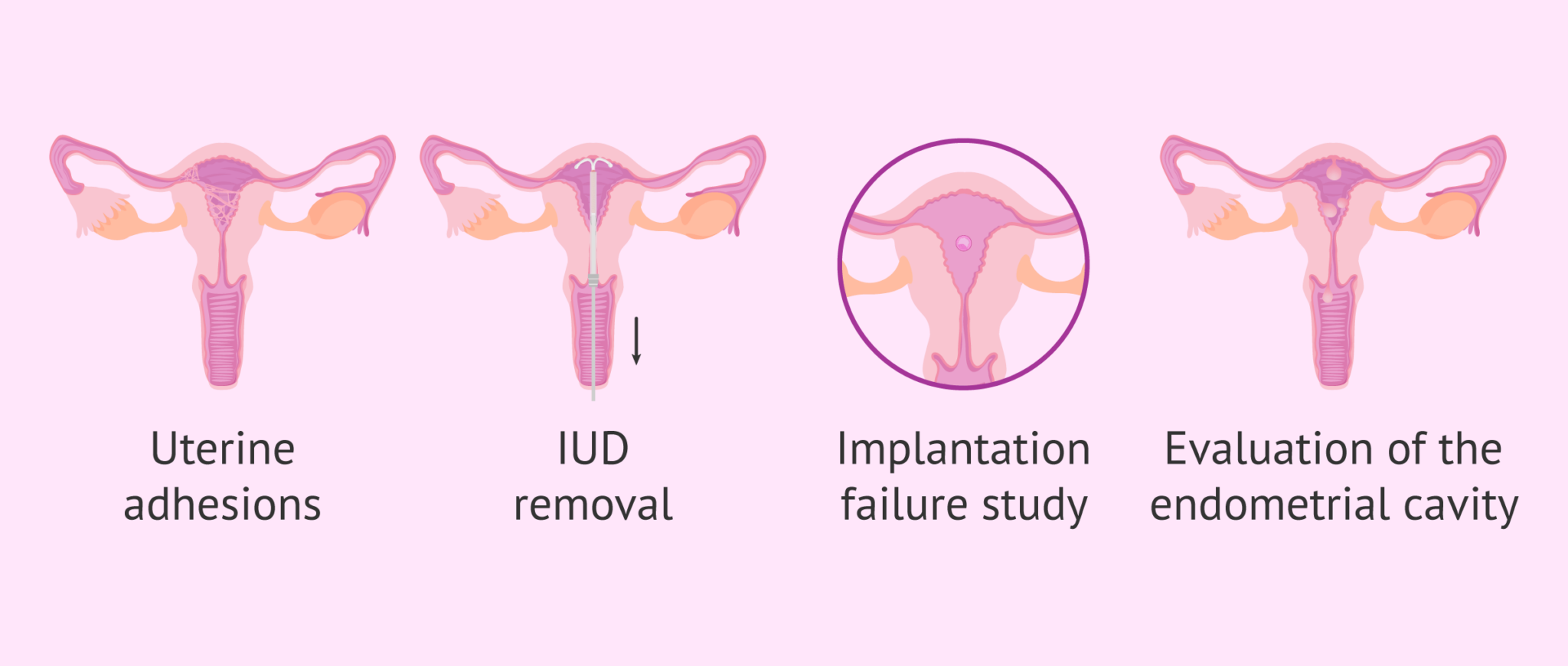 Image result for hysterectomy genetic testing for women