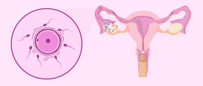 Imagen: Obstacles of the female reproductive tract