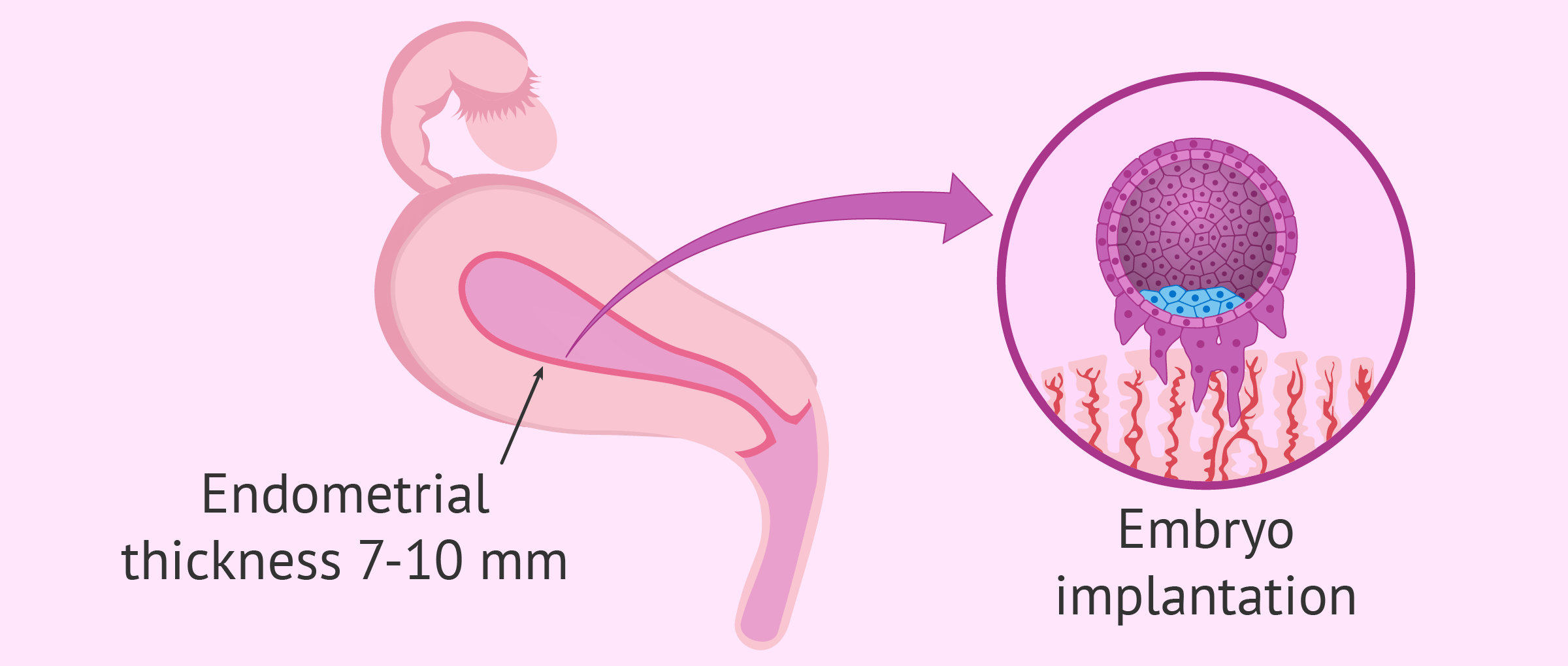 Implantacion embrion fiv
