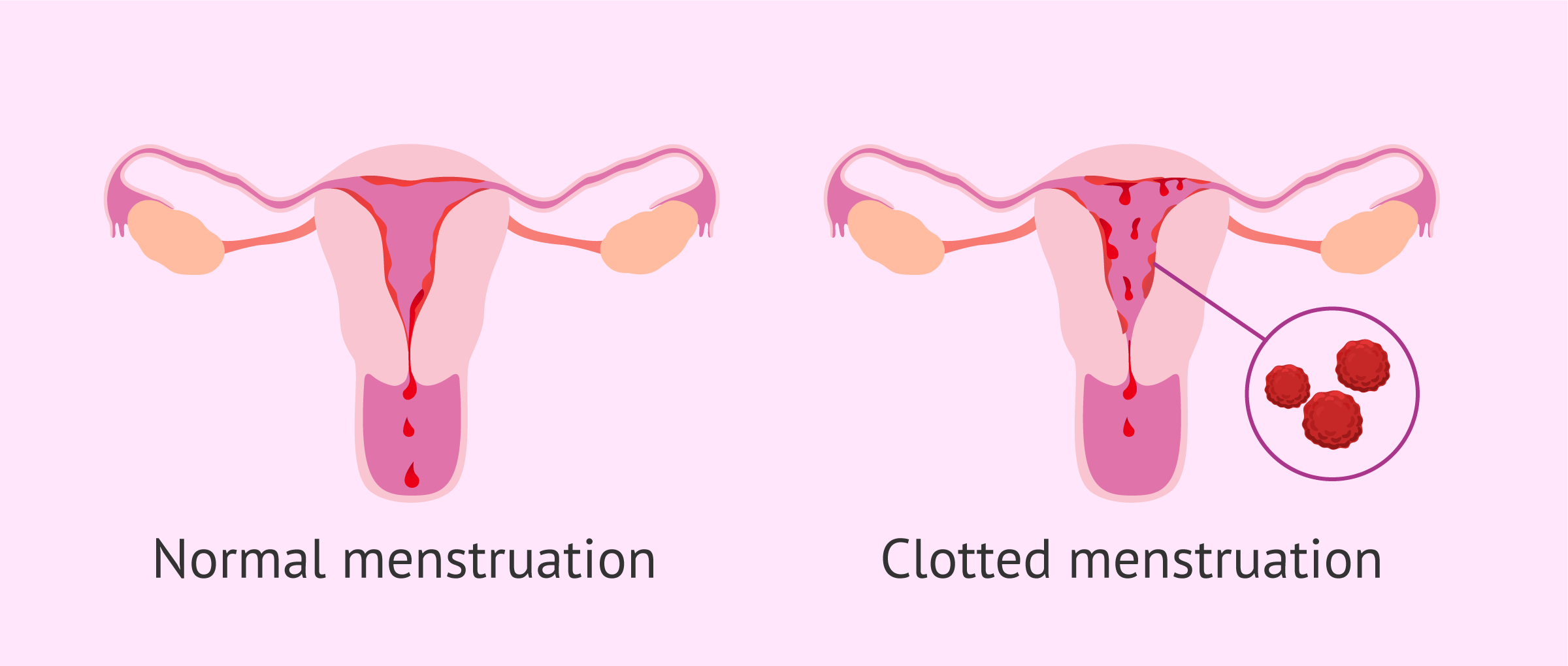 Endometriosis period blood: Color, clots, appearance, and more