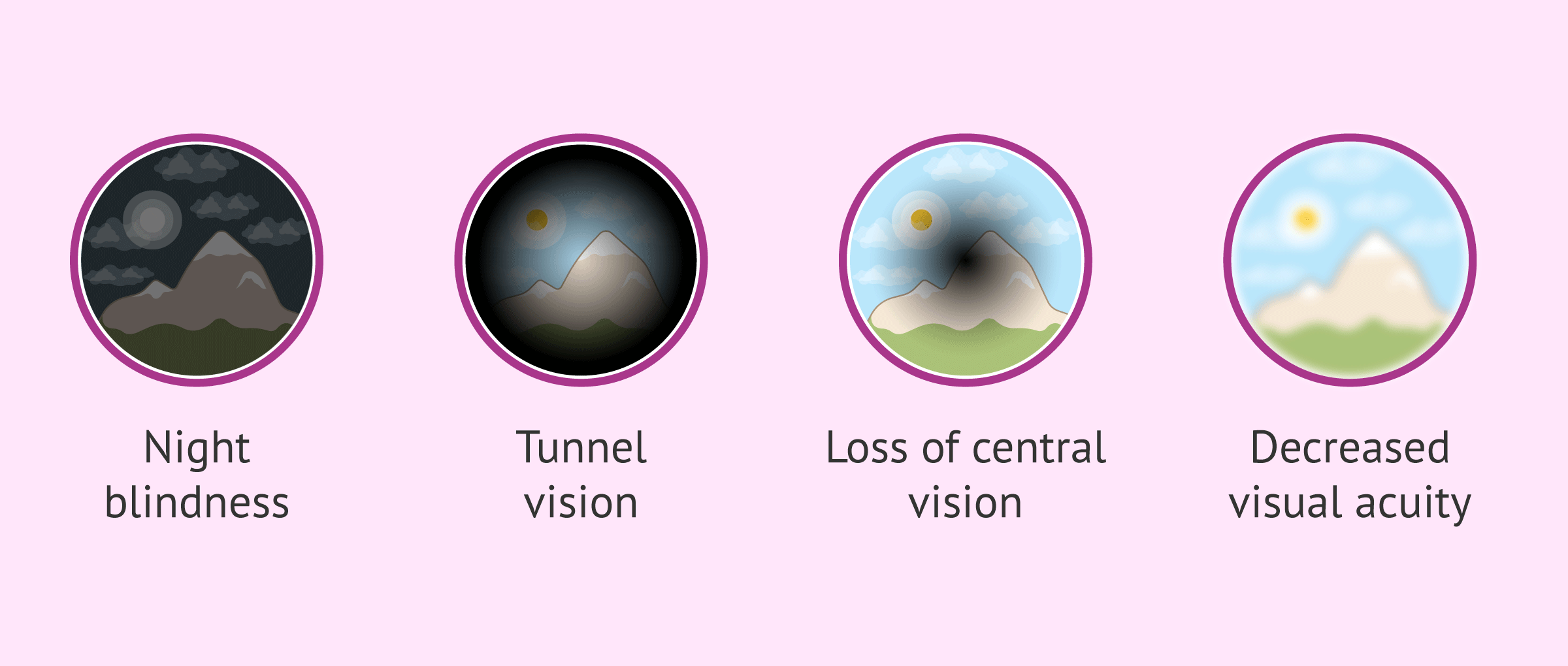 Imagen: Main symptoms of retinitis pigmentosa