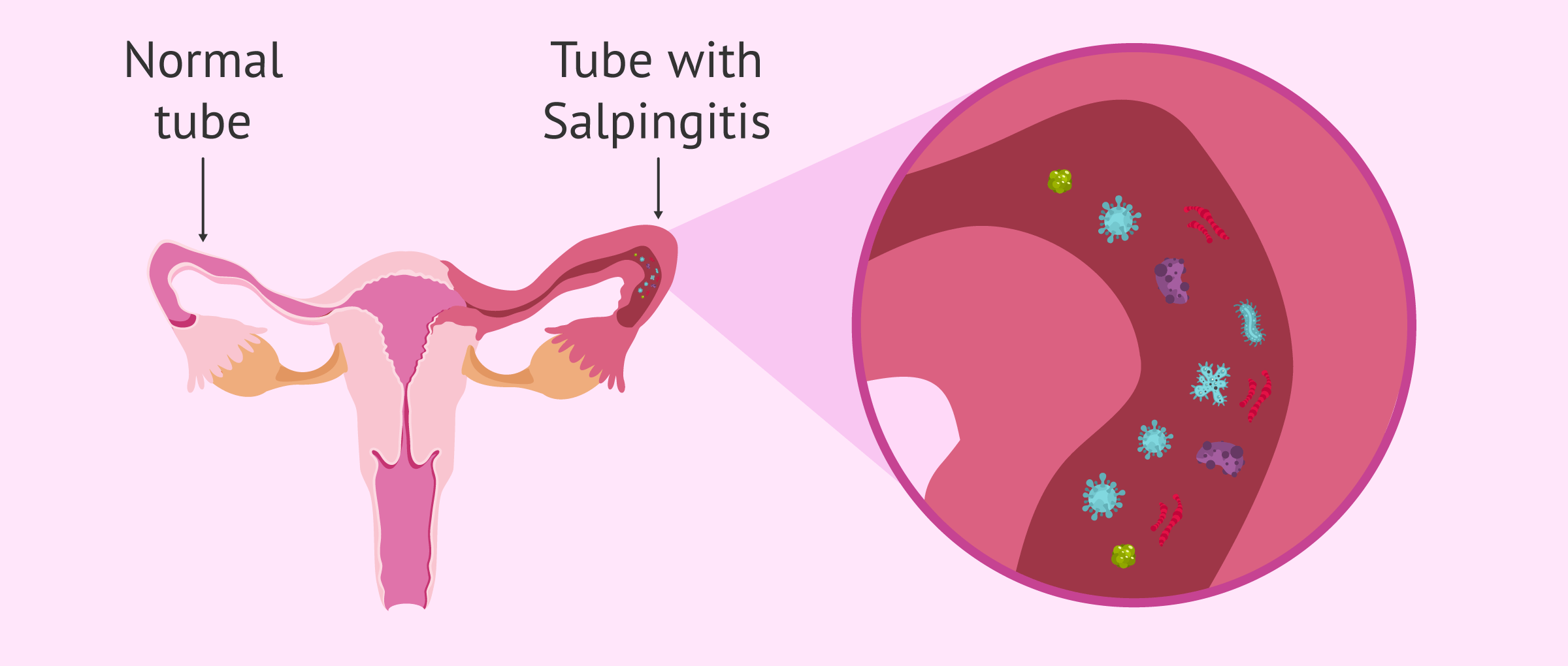 Unilateral salpingitis