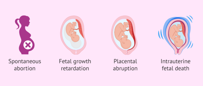Imagen: Consequences of thrombocythemia in pregnancy