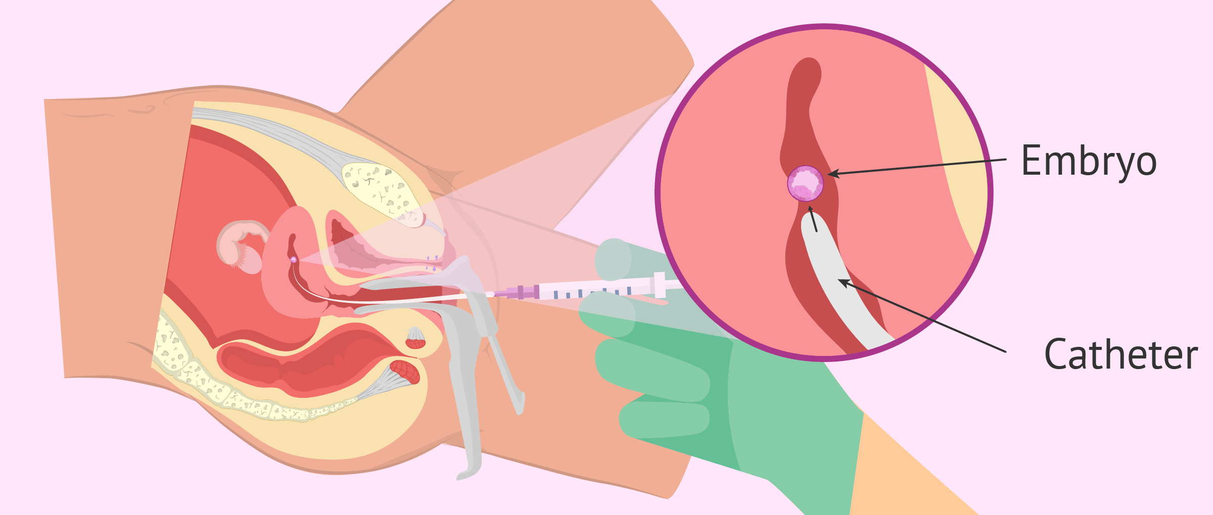 Embryo Transfer (ET)