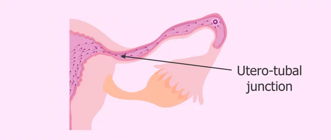 Imagen: Sperm transport through the uterotubal junction