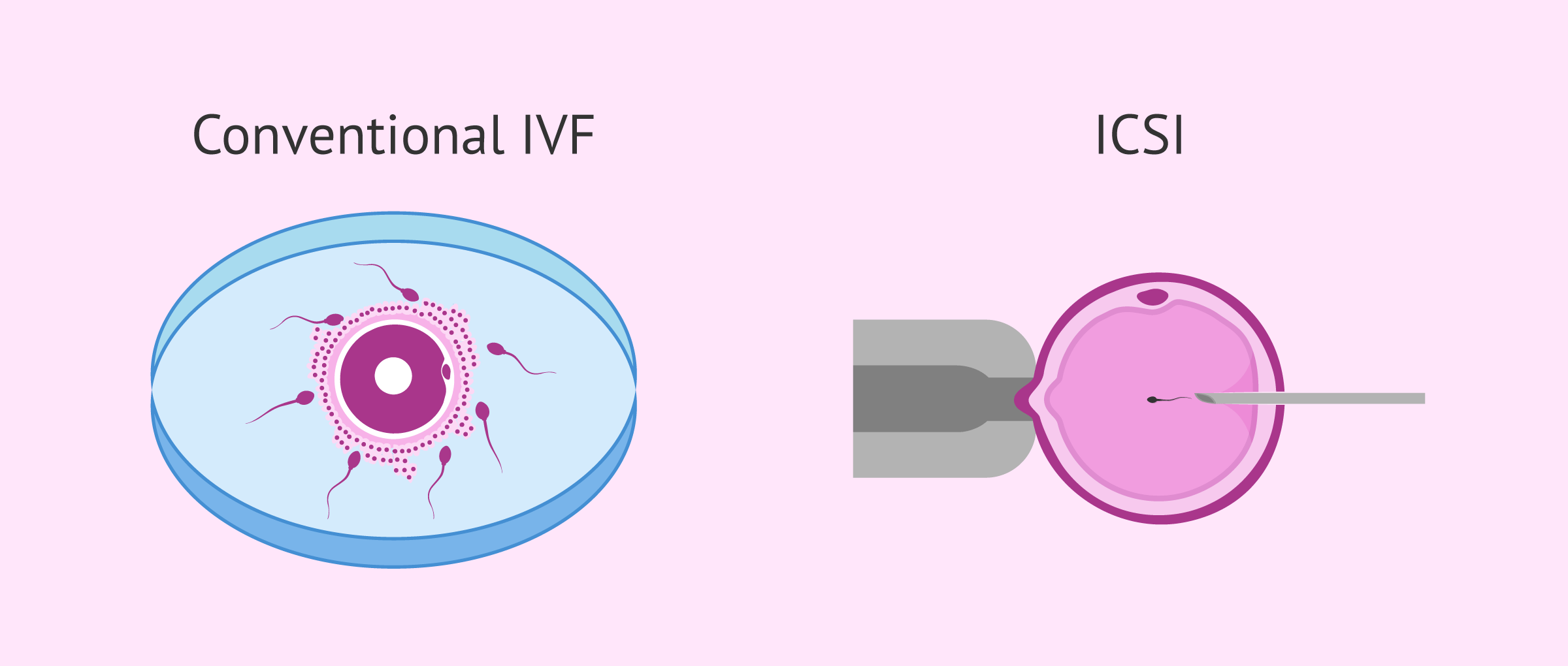 Imagen: Difference between ICSI and IVF