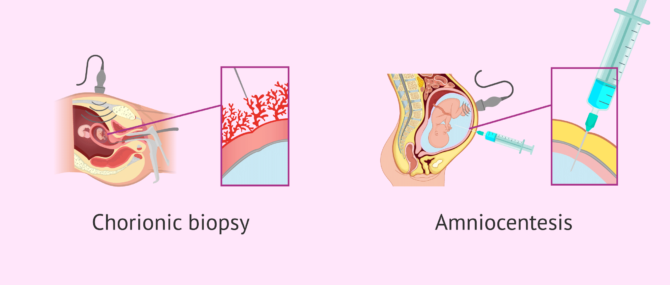 Imagen: Invasive tests that can determine the baby's sex