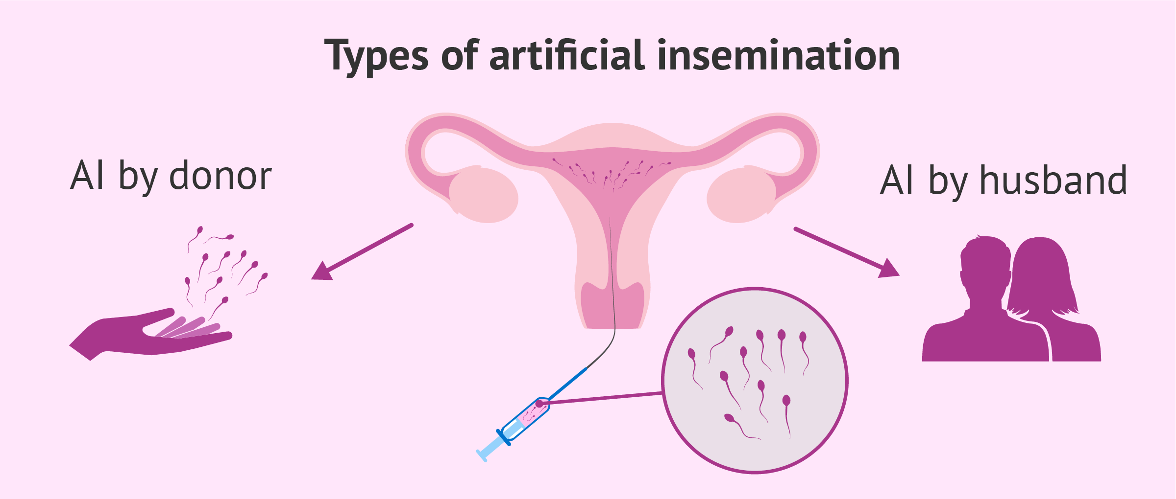 Types of artificial insemination AIH or AID
