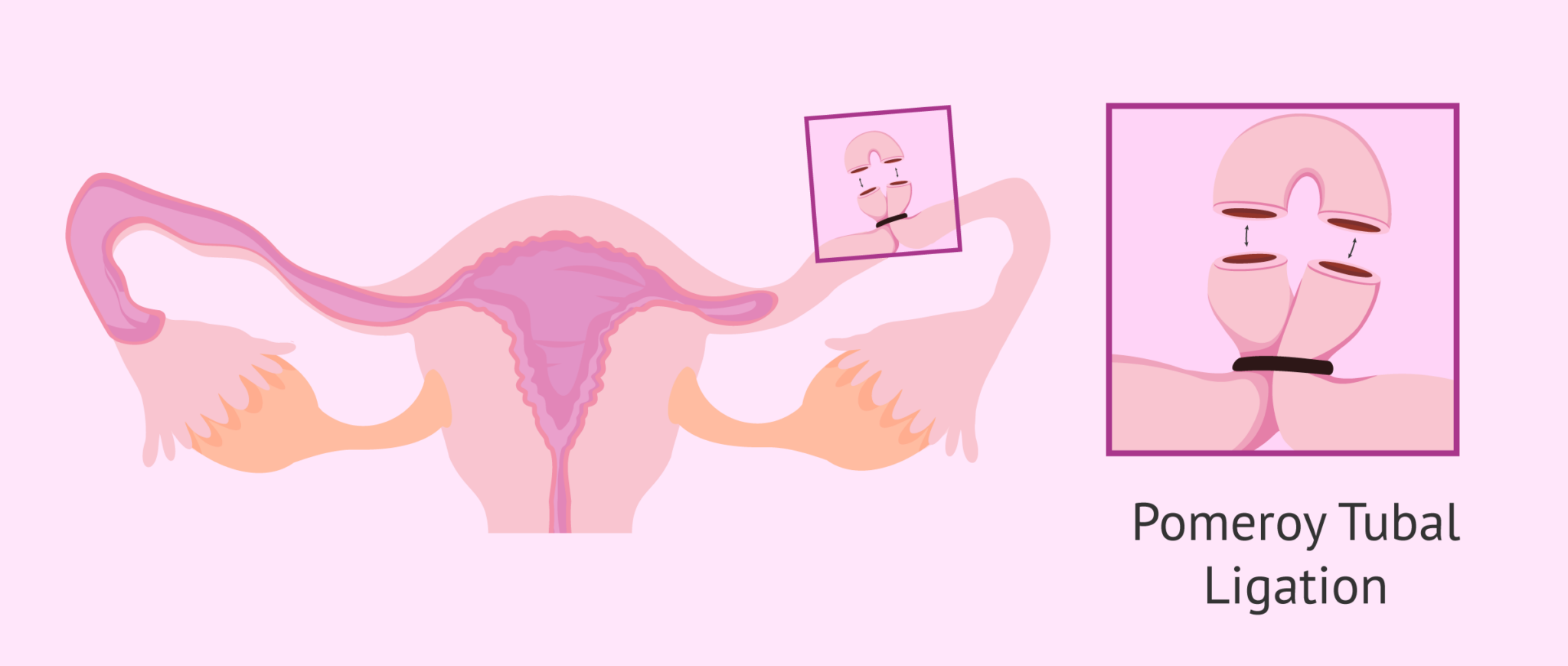 What is tubal ligation? Advantages and consequences