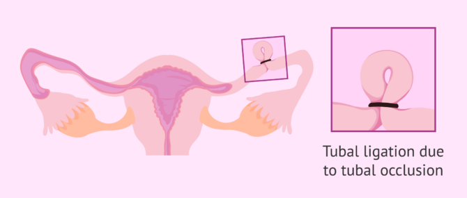 What is tubal ligation? – Advantages and consequences