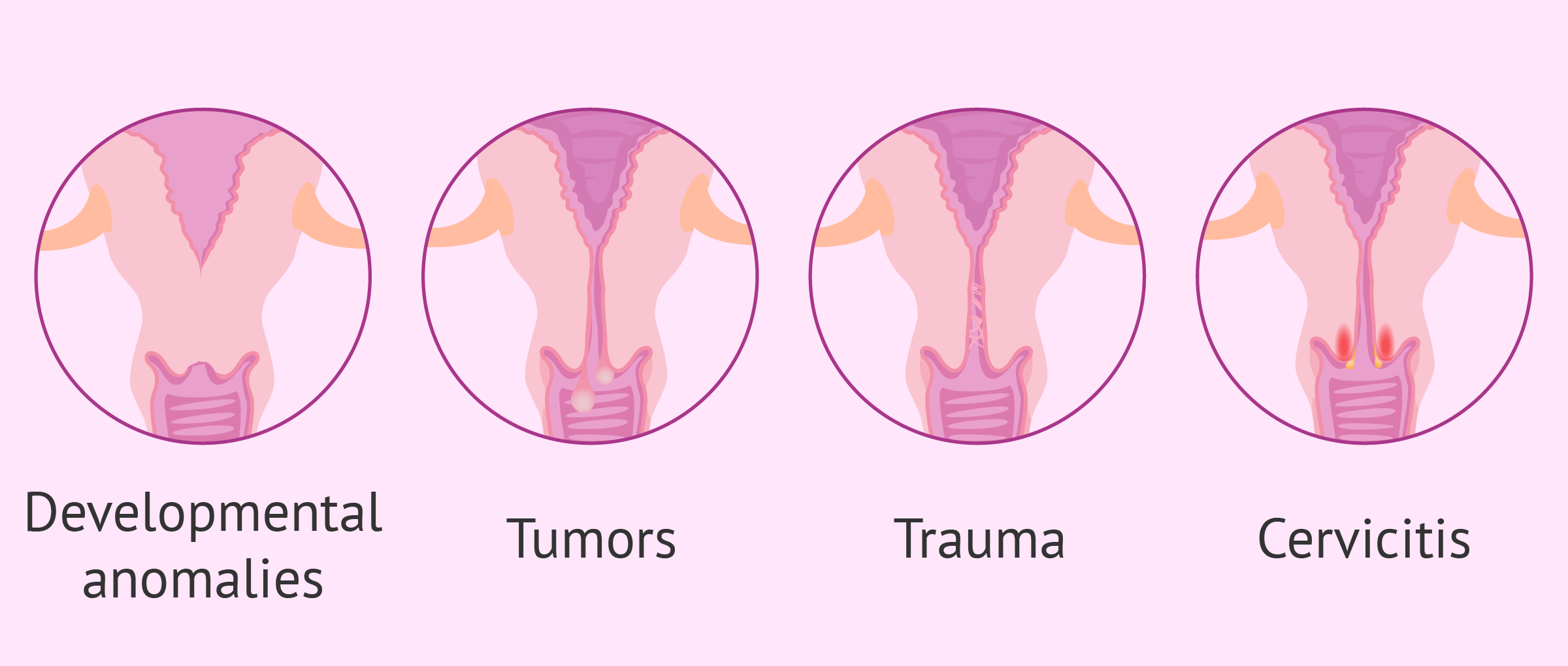 Cervical factor female sterility due to cervical abnormalities. pic