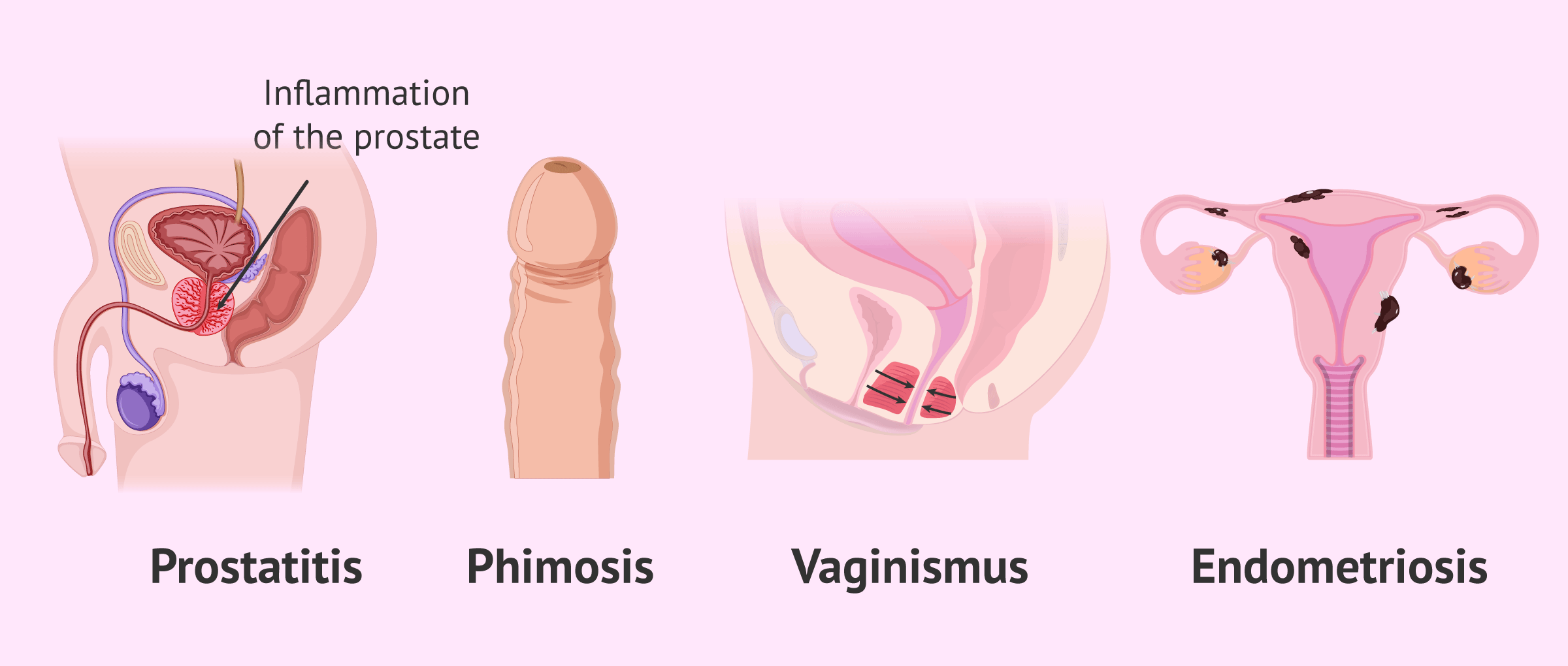Imagen: Causes of painful intercourse