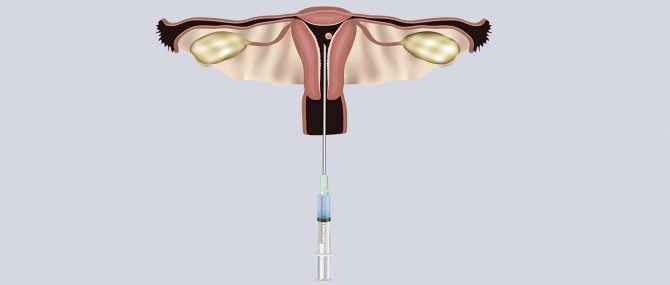 Single embryo transfer (SET)