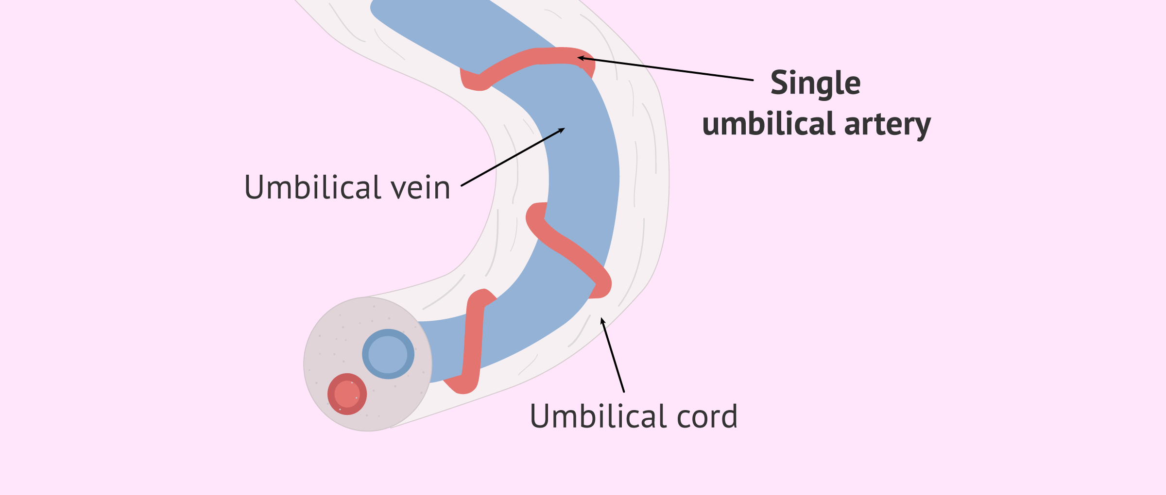 Umbilical cord anomalies - single umbilical artery