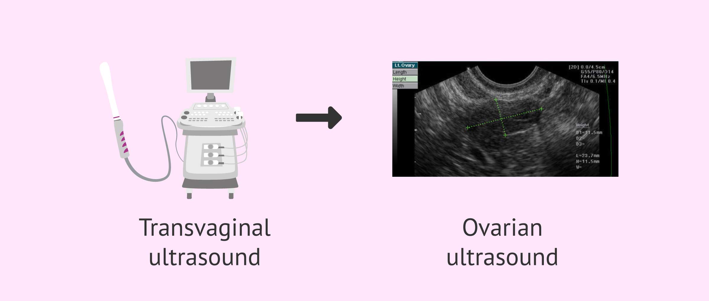 Antral follicle count by transvaginal ultrasound scanning