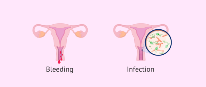 Imagen: Egg retrieval risks