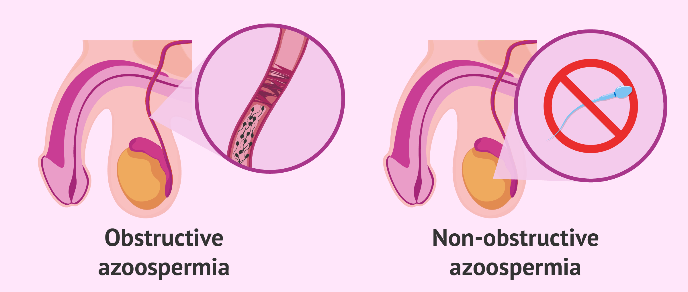 Types of azoospermia