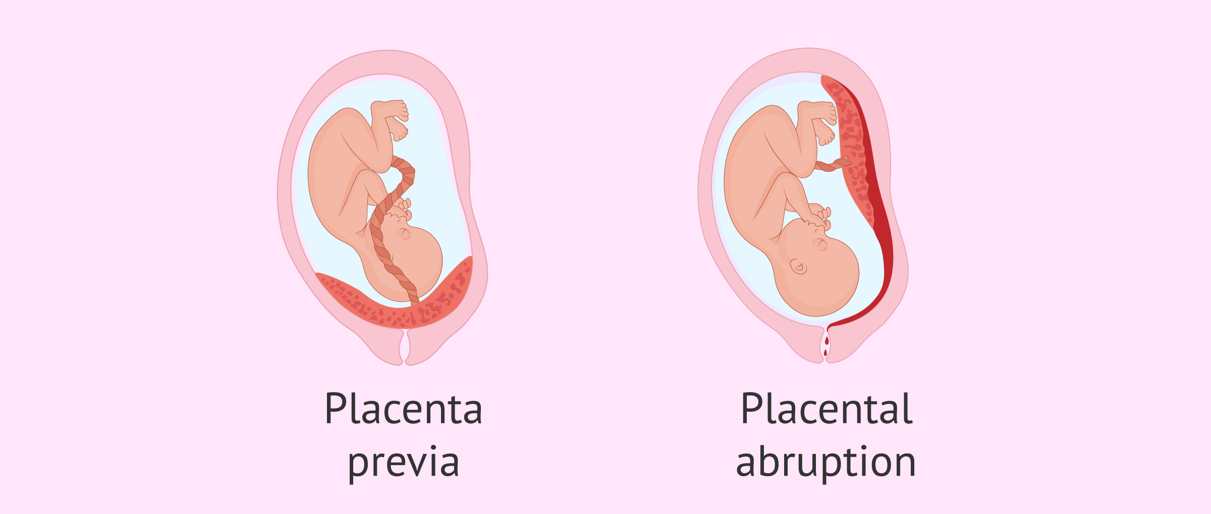 Complications in pregnancy due to problems in the placenta