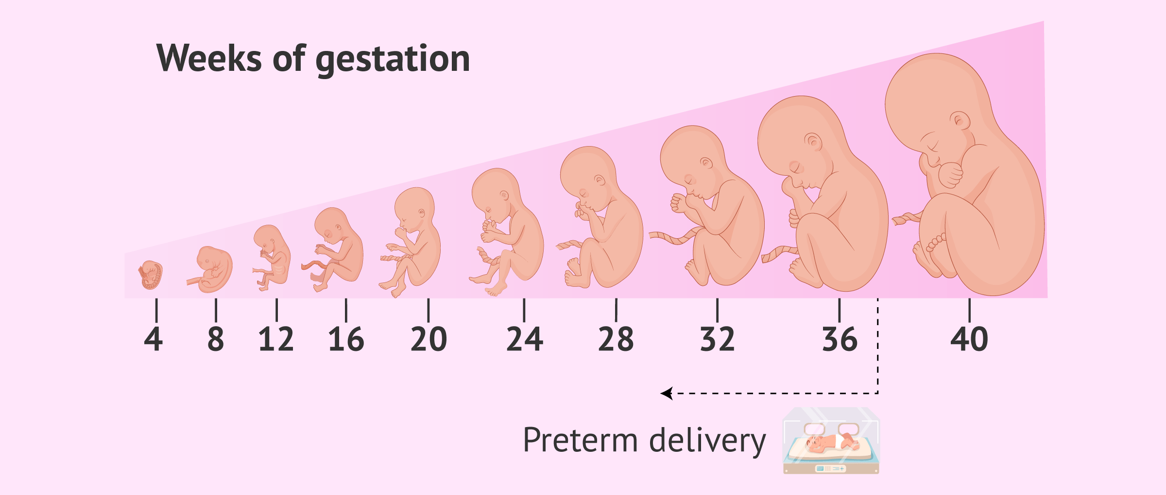 Preterm delivery as a possible complication of pregnancy