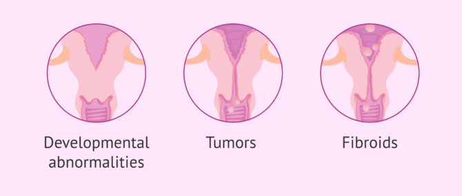 Imagen: Causes of sterility due to cervical factor