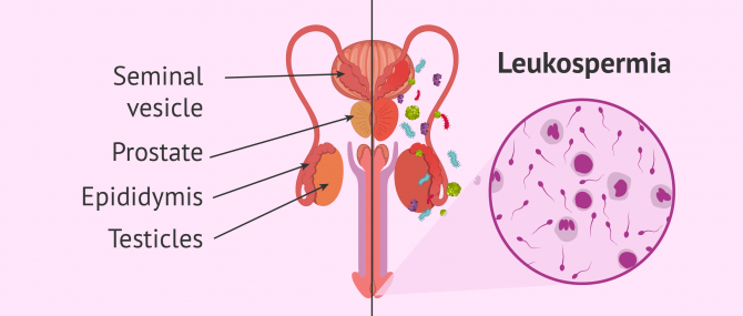 Genital tract infection and leukospermia