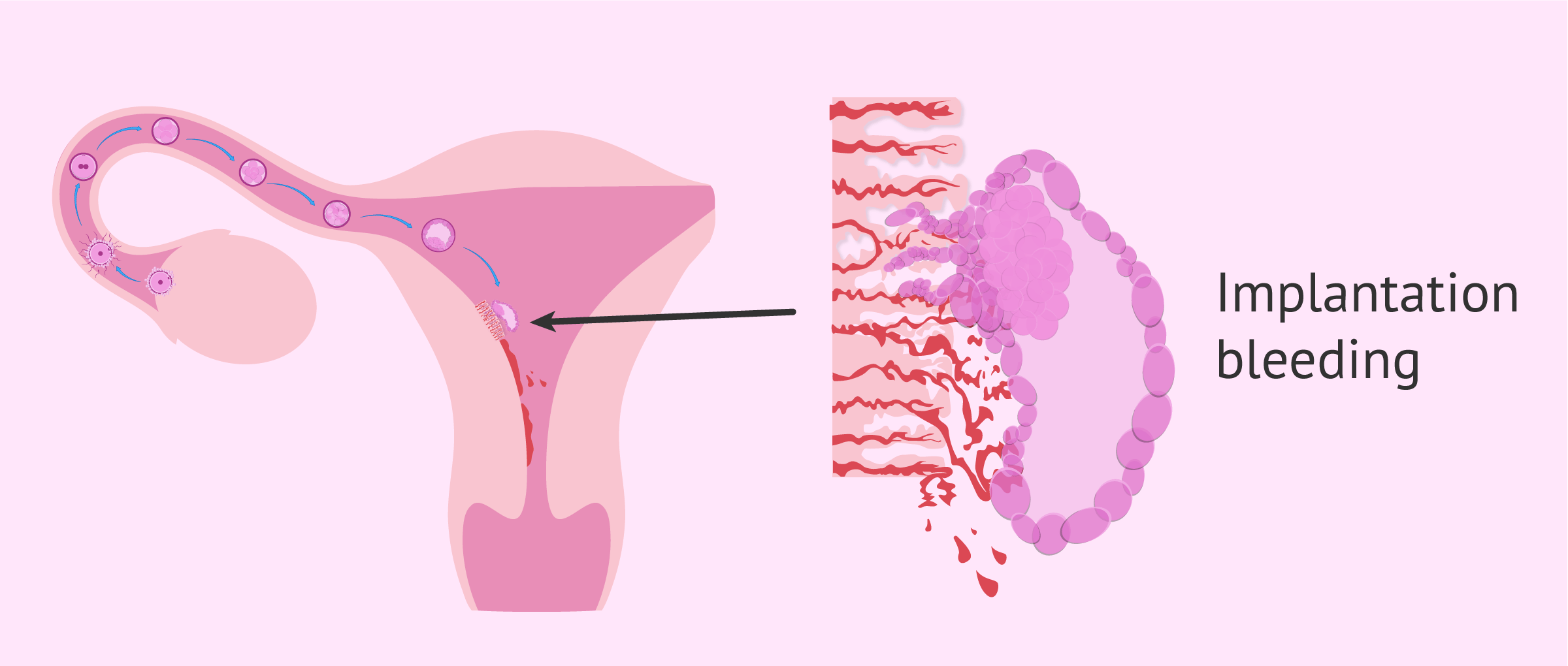 After Implatation Bleeding Can You Hav a Period or It Stops