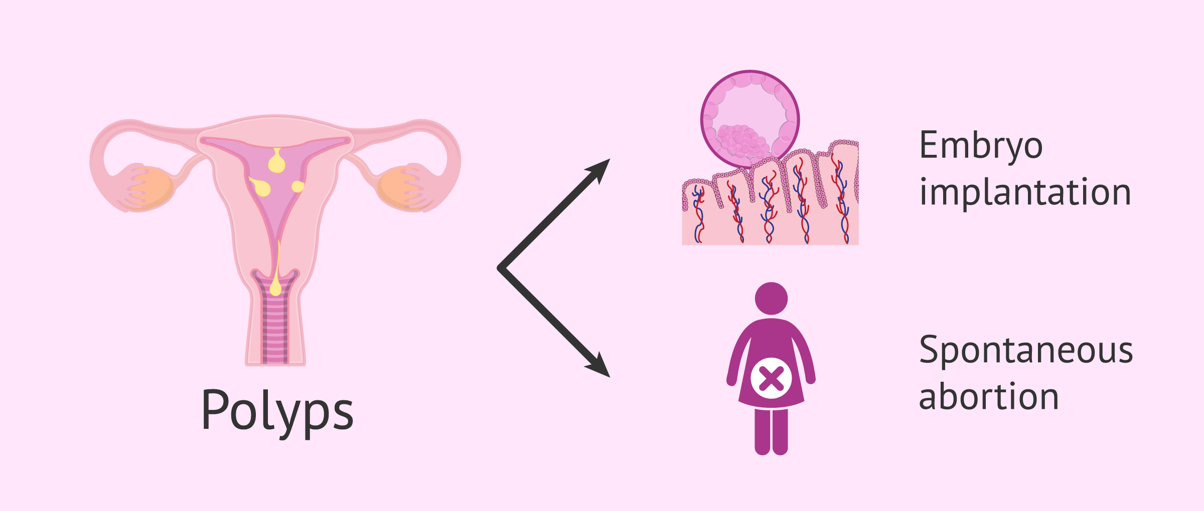 Uterine polyps and fertility