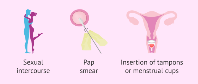 Symptoms of vaginismus