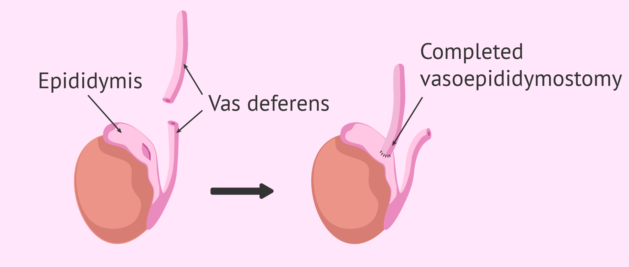 Process of vasoepididymostomy