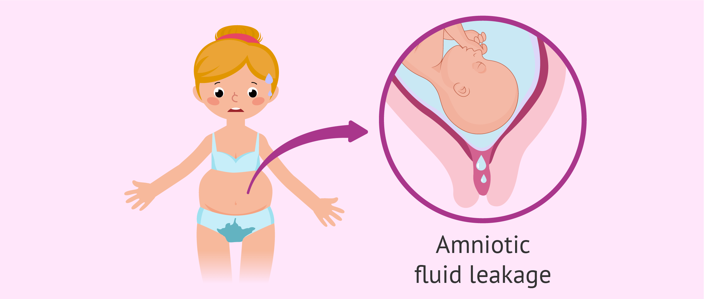 Amniotic fluid leakage: how to tell