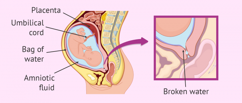 Assisted Rupture Of Membranes Preterm premature rupture of membranes (PPROM)