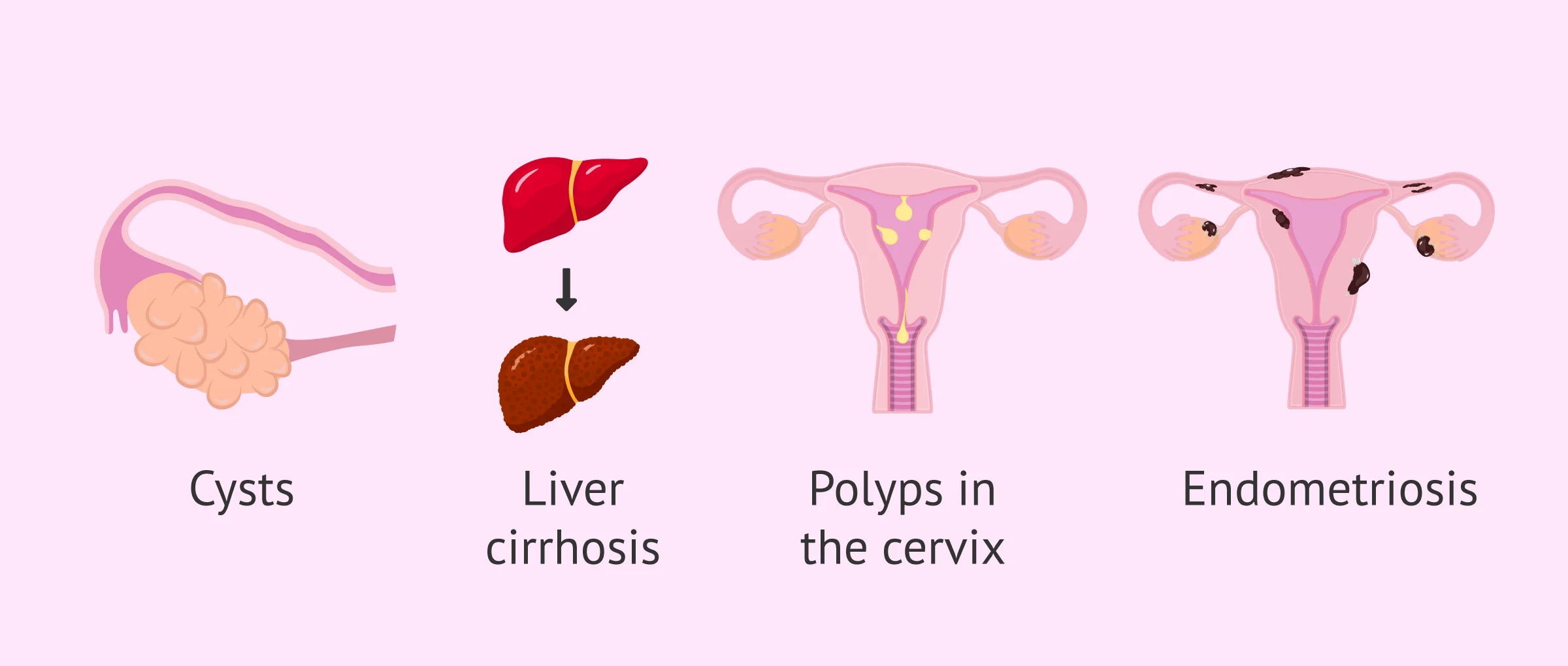 Risk factors for endometrial hyperplasia